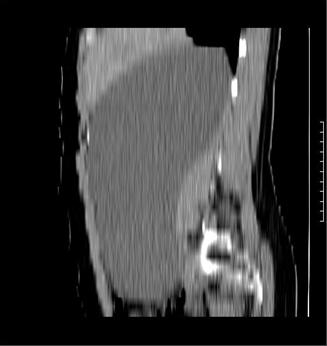 quiste_retroperitoneal_caso/figura_2_3