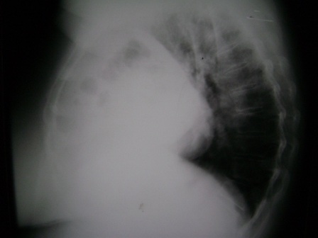 sindrome_Chilaiditi_eventracion_diafragmatica/Fig2_masa_mediastino