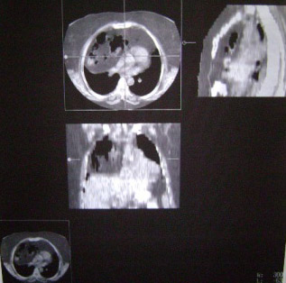 sindrome_Chilaiditi_eventracion_diafragmatica/Fig3_ultrasonido_abdominal