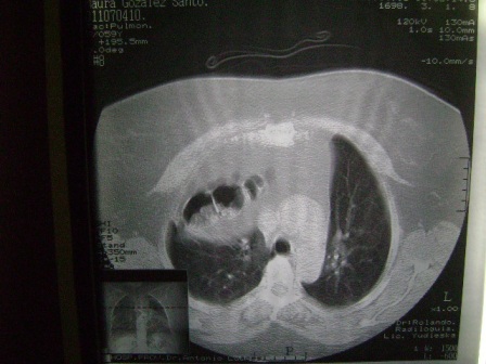 sindrome_Chilaiditi_eventracion_diafragmatica/Fig4_TAC_toracoabdominal