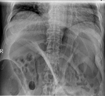 suboclusion_oclusion_intestinal/radiografia_RX_volvulo