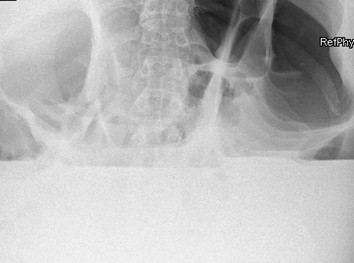 suboclusion_oclusion_intestinal/radiografia_abdomen_lateral