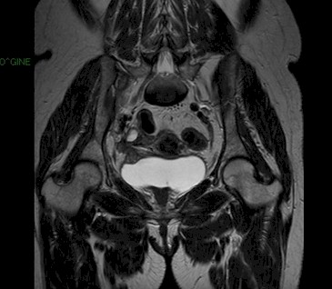 uropatia_carcinoma_tiroides/TAC_abdominal_metastasis