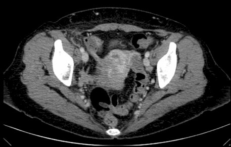 uropatia_carcinoma_tiroides/TAC_metastasis_urologia