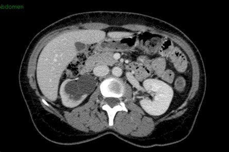 uropatia_carcinoma_tiroides/obstruccion_urinaria_metastasis