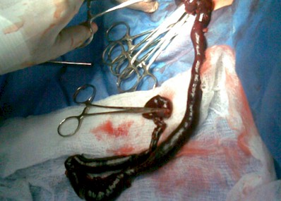 volvulo_necrosis_intestino/cirugia_reseccion_intestinal volvulo_necrosis_intestino/cirugia_reseccion_intestinal