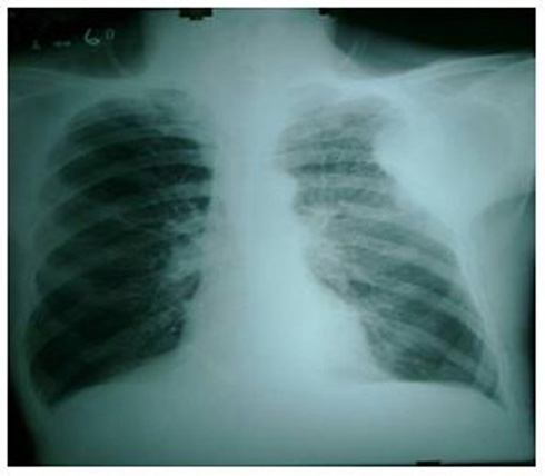 caso_mesotelioma_pleural/tumor_mesenquimal_frontal caso_mesotelioma_pleural/tumor_mesenquimal_frontal