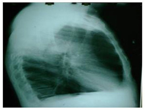 caso_mesotelioma_pleural/tumor_mesenquimal_lateral caso_mesotelioma_pleural/tumor_mesenquimal_lateral