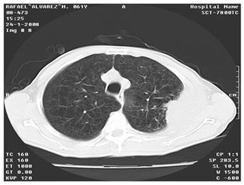 caso_mesotelioma_pleural/tumor_mesenquimal_ultrasonografia caso_mesotelioma_pleural/tumor_mesenquimal_ultrasonografia