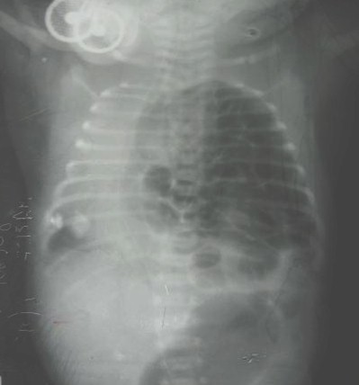 hernia_diafragmatica_congenita/radiografia_defecto_diafragma