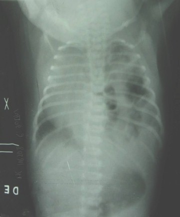 hernia_diafragmatica_congenita/radiografia_rx_recien_nacido hernia_diafragmatica_congenita/radiografia_rx_recien_nacido
