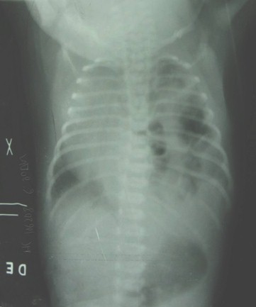 hernia_diafragmatica_congenita/radiografia_rx_recien_nacido