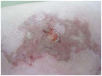 loxoscelismo_cutaneo_oxigenacion_hiperbarica/imagen1_sesion16 loxoscelismo_cutaneo_oxigenacion_hiperbarica/imagen1_sesion16