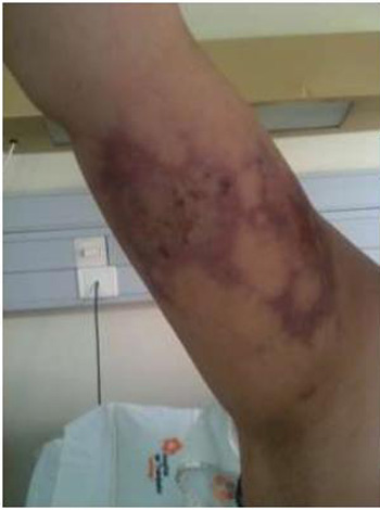 loxoscelismo_cutaneo_oxigenacion_hiperbarica/imagen1_sesion9 loxoscelismo_cutaneo_oxigenacion_hiperbarica/imagen1_sesion9