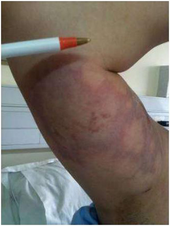 loxoscelismo_cutaneo_oxigenacion_hiperbarica/imagen2_sesion1 loxoscelismo_cutaneo_oxigenacion_hiperbarica/imagen2_sesion1