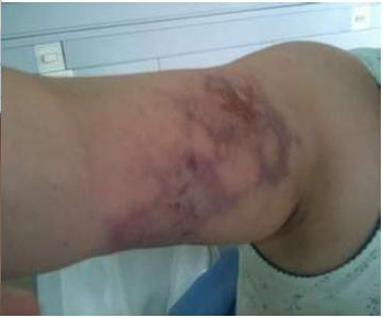 loxoscelismo_cutaneo_oxigenacion_hiperbarica/imagen2_sesion9 loxoscelismo_cutaneo_oxigenacion_hiperbarica/imagen2_sesion9