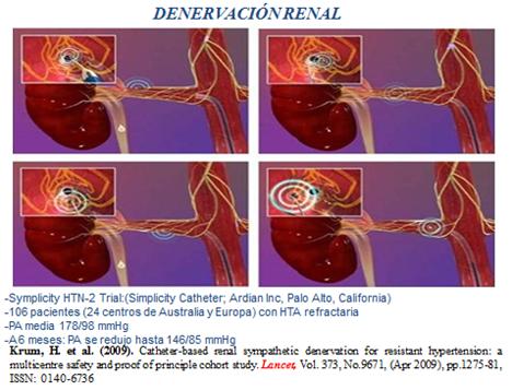 novedades_terapia_antihipertensiva/denervacion_renal. novedades_terapia_antihipertensiva/denervacion_renal.