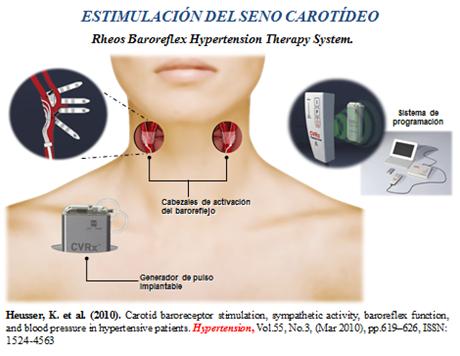 novedades_terapia_antihipertensiva/estimulacion_seno_carotideo novedades_terapia_antihipertensiva/estimulacion_seno_carotideo