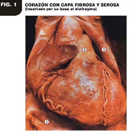 patologia_electroionica_cancer/fibrosa_serosa_corazon