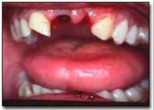 traumatismos_dentales_ejercito/avulsion_21_22 traumatismos_dentales_ejercito/avulsion_21_22