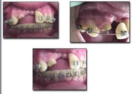 traumatismos_dentales_ejercito/caso_intrusion_fractura traumatismos_dentales_ejercito/caso_intrusion_fractura