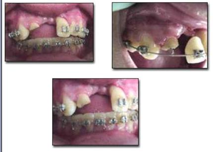 traumatismos_dentales_ejercito/caso_intrusion_fractura