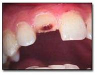 traumatismos_dentales_ejercito/fractura_complicada_corona traumatismos_dentales_ejercito/fractura_complicada_corona