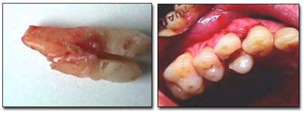 traumatismos_dentales_ejercito/fractura_corona_raiz