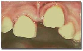 traumatismos_dentales_ejercito/luxacion_lateral_extrusiva traumatismos_dentales_ejercito/luxacion_lateral_extrusiva