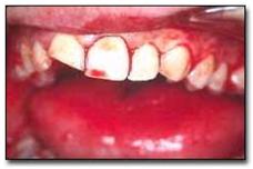 traumatismos_dentales_ejercito/reimplantacion_21_22