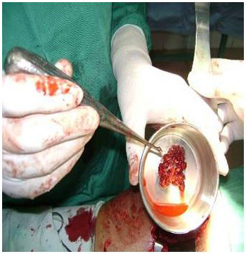 tumor_femur_derecho/legrado_lesion_para_biopsia