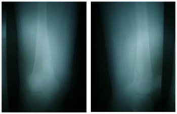 tumor_femur_derecho/lesion_ovalada_metastasis_femur_derecho