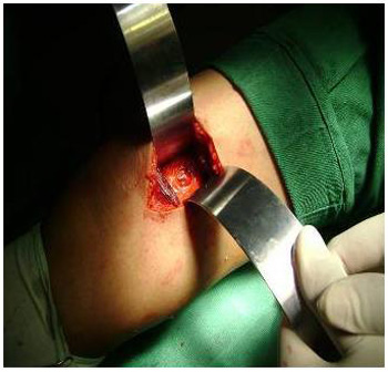 tumor_femur_derecho/localizacion_lesion