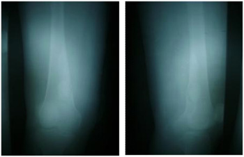 tumor_femur_derecho/osteointegracion_injerto