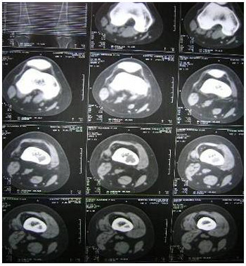 tumor_femur_derecho/tac