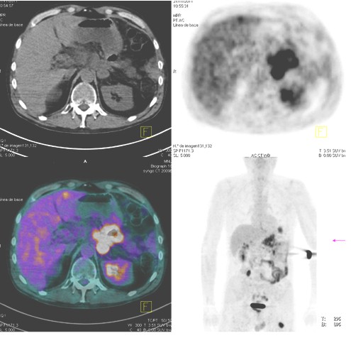 tumor_quistico_pancreas/PET_TAC_lesion