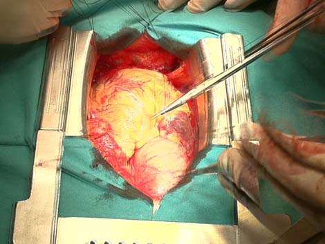 cirugia_twitter_cardiaca/007 cirugia_twitter_cardiaca/007