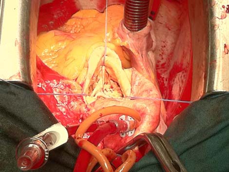 cirugia_twitter_cardiaca/014 cirugia_twitter_cardiaca/014