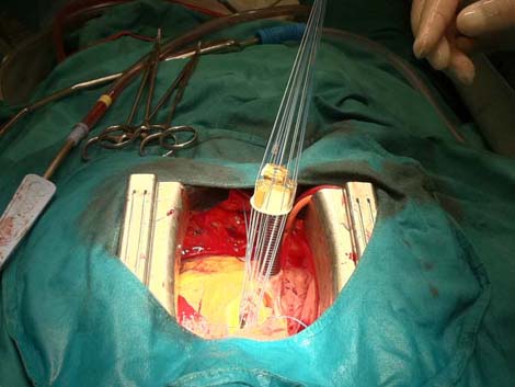 cirugia_twitter_cardiaca/017 cirugia_twitter_cardiaca/017