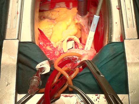 cirugia_twitter_cardiaca/018 cirugia_twitter_cardiaca/018