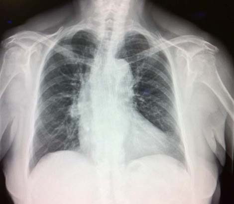 cirugia_twitter_cardiaca/RX_torax_1 cirugia_twitter_cardiaca/RX_torax_1