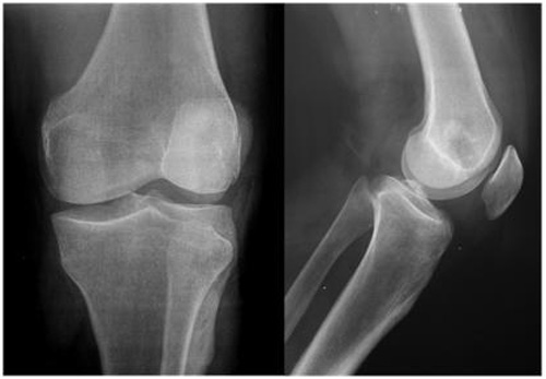 impactacion_condilo_femoral/radiografia_ap_lateral