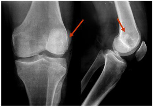 impactacion_condilo_femoral/radiografia_ap_lateral_hallazgos_patologicos