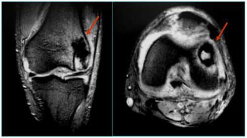 impactacion_condilo_femoral/rnm_rodilla_1 impactacion_condilo_femoral/rnm_rodilla_1