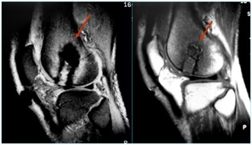 impactacion_condilo_femoral/rnm_rodilla_2