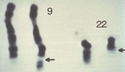 leucemia_mieloide_cronica/cromosoma_filadelfia_ph