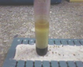 leucemia_mieloide_cronica/sangre_plasma_suero