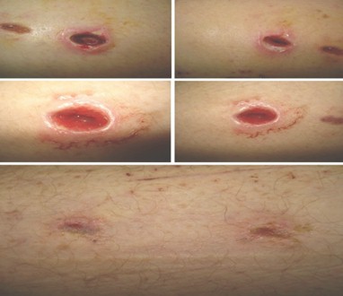 terapia_pico_heridas/evolucion_favorable_VAC