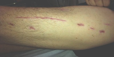 terapia_pico_heridas/resultado_curas_vacio terapia_pico_heridas/resultado_curas_vacio