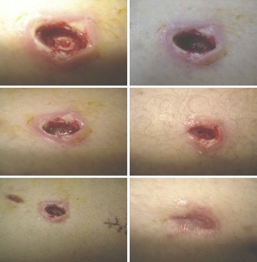 terapia_pico_heridas/ulceras_cronicas_vacio